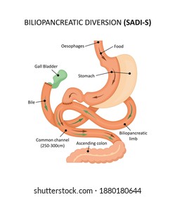 Biliopancreatic diversion (sadi-s). Gastric bypass. Vector illustration