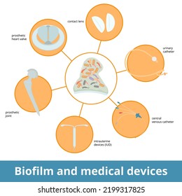 Biofilm and medical devices. Common sources of biofilm growth and development, including contact lens, prosthetic heart valve and joint, central venous and urinary catheter, intrauterine device (IUD).