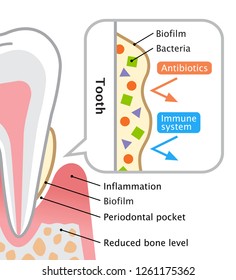 Biofilm On Tooth Illustration. Dental And Oral Care Concept