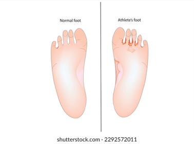 Biological illustration of Athlete’s foot