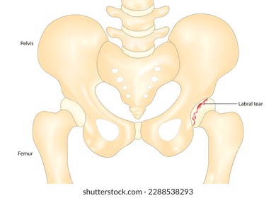 Biological vector of Hip labral tear