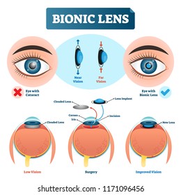 Bionic lens vector illustration. Labeled medical scheme with cataract. Isolated diagram with implant, clouded lens, cornea, incision and iris. Low and improved vision.