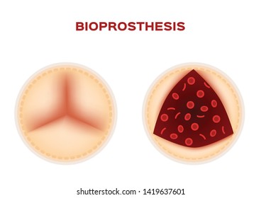 bioprosthesis and an aortic valve replacement vector