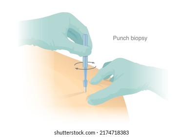 Biopsie-Stempel. Schneiden Sie das Probengewebe an der Schulter des Patienten mit einem medizinischen Instrument zur Diagnose und Hautkrebsbehandlung. Kreislaufskalpell.