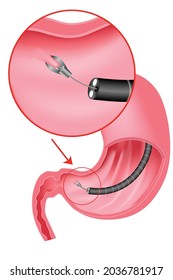 Biopsy of the stomach. Taking a sample of the mucous membrane for research. Introduction of the endoscope through the esophagus. Gastroscopy. Vector illustration
