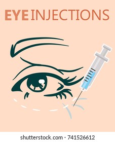 biorevitalization with hyaluronic acid treatment of mimic wrinkles under the eyes reduces unwanted signs of aging including wrinkles around eyes and mouth young skin results.