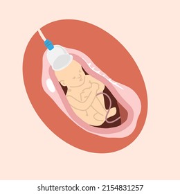 Birth baby Vacuum process for obgyn and medical content