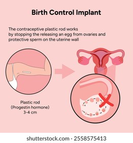 Birth control implant, advantages and disadvantages