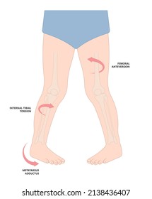 Birth infant genu valgum varum criss cross and club foot tailor body side W Sitting wrong bad position of bent hip Bow leg knock knees in core kids children baby back pain poor toed walking