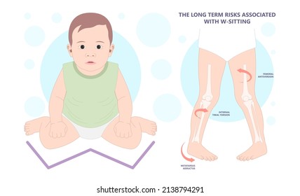 	
Birth infant genu valgum varum criss cross and club foot tailor body side W Sitting wrong bad position of bent hip Bow leg knock knees in core kids children baby back pain poor toed walking