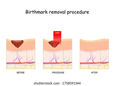 Birthmark laser Removal. Treatment. Before and after procedure