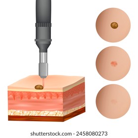 Birthmark laser Removal. Treatment Nevus. Before and after procedure. Removing mole by medical laser