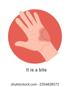 Bite On Hand Symptom Vector Illustration