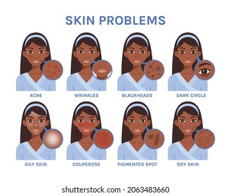 Black African Woman with Skin Problems. Close up of Pimples, Blackheads, Wrinkles and Age Spots. On a Face, Dry and Oily Skin, Rosacea, Couperose. Dark Circles under the Eyes. Image for Beauty Design.