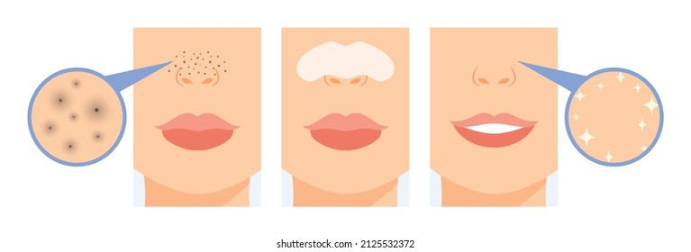 Black Dots on Female Nose. Dirty Skin and Clogged Pores. Woman Use Nose Strips. Before and After. Zoom. Close up view of Blackhead. Clean Skin and Happy Smile on Face. Cartoon style. Vector image.