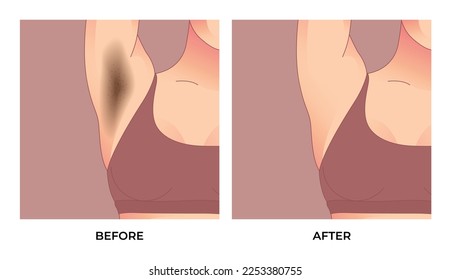 Black underarm, before and after skin care cosmetology armpits epilation treatment. svg