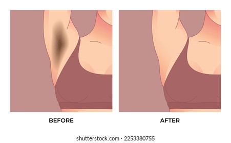 Black underarm, before and after skin care cosmetology armpits epilation treatment.