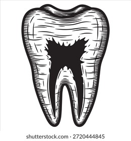 Ilustração em preto e branco de um dente humano com uma grande cárie dentária