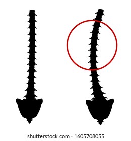 Black and white silhouette icon scoliosis. Spinal curvature, kyphosis, lordosis of the neck, scoliosis, arthrosis. Improper posture and stoop. Infographics Vector illustration on isolated background.