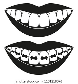 Black and white teeth aligning elements silhouette. Before and after toothy smile with braces. Achieving beautiful smile concept. Dentalcare vector illustration for icon, label, badge decoration