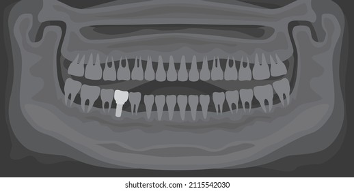 Rayo X en blanco y negro de mandíbula humana con dientes normales e implante dental. Diente después del procedimiento dental. Implante quirúrgico en cavidad oral. Tratamiento, odontología, atención médica. Radiografía con prótesis