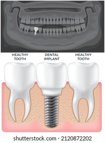 Black and white x-ray of jaw above human gum with normal teeth and dental implant. Tooth after medical procedure, dental treatment. Surgical implant in oral cavity. Radiograph with prosthesis