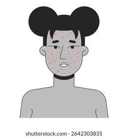 Rosto de mulher negra com grave ilustração de contorno de acne. Espinhas, rosácea, pústulas. Mulher afro-americana pele facial rompe personagem de linha 2D isolado em branco. Imagem linear de tinta vetorial monocromática