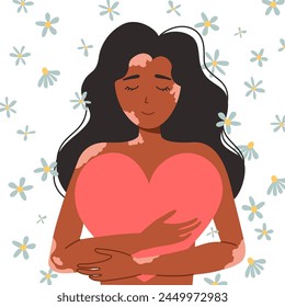 Mujer negra con vitíligo, positividad corporal, amor propio. Una mujer abraza un gran corazón. Ilustración vectorial