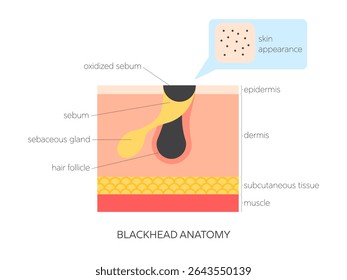 Ilustração de vetor plano Blackhead (comedone aberto). Infográfico médico mostrando a estrutura da pele, acúmulo de sebo, bloqueio folicular e visão superficial. Cuidados com a pele e conceito dermatológico.