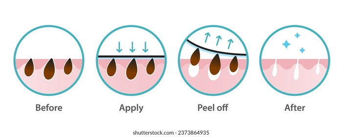 Blackhead removal process vector icon set illustration on white background. Cross section of  blackhead pore strip treatment, apply, peel off, unclogging and tighten pores. Before and after concept.
