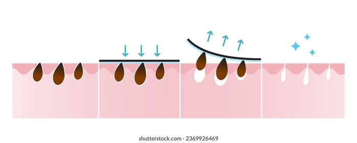 Blackhead removal process vector illustration isolated on white background. Cross section of  blackhead pore strip treatment, apply, peel off, unclogging and tighten pores. Before and after concept.
