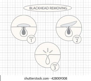 Blackhead removing