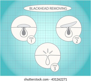 Blackhead removing