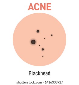 Blackhead skin acne type vector icon. Skin disease acne whiteheads pimples type and face pore comedones
