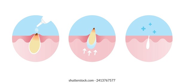 Blackhead treatment gel vector icon set illustration on white background. Cross section of use acne cream, reduce clogged pore, non inflammatory acne and tighten pore. Skin care and beauty concept.