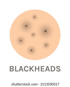 Blackheads. Isolated Black Dots on Skin. Icon. Zoom. Close Up of Skin Problems. Flat Color Cartoon style. White background. Illustration for Medical and Beauty Design. Vector.