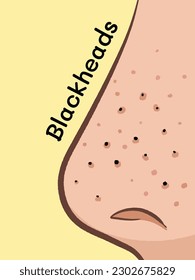 Blackheads on close up nose vector illustration isolated on yellow vertical background. Side view cartoon drawing with simple flat art style.