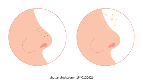 Blackheads on nose cleaning flat illustration. Washing face with clogged pores. Blackheads removal, skin cleaning, skincare. Can be used for topics like cosmetology, cosmetics. Shrinking and minimaizi