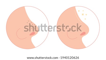 Blackheads on nose cleaning flat illustration. Washing face with clogged pores. Blackheads removal, skin cleaning, skincare. Can be used for topics like cosmetology, cosmetics. Shrinking and minimaizi
