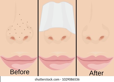 Blackheads on Nose vector illustration showing skin problems