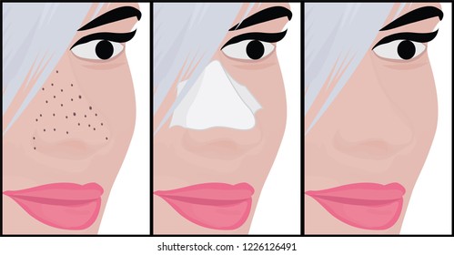 Blackheads on Nose vector illustration showing skin problems