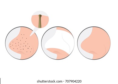 Blackheads on Nose vector illustration showing skin problems