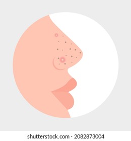 Blackheads and red pimples on the nose. Man's face in profile. Problem skin. Vector illustration, flat minimal cartoon design, isolated on white background, eps10.