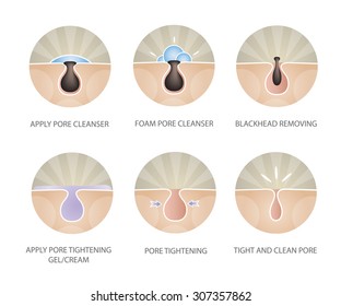 Blackheads Removing And Pore Cleansing Symbols Set.