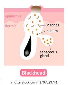 
Blackheads are a symptom of mild acne, which are open pores. skin care concept.  Isolated on white background
