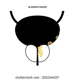 Bladder Cancer Icon. Stones In Bladder, Urethra, Lymph Nodes And Prostate In Male Body. Inflammation, Pain, Tumor In Human Urinary System. Internal Organs Exam Vector Illustration On White Background.