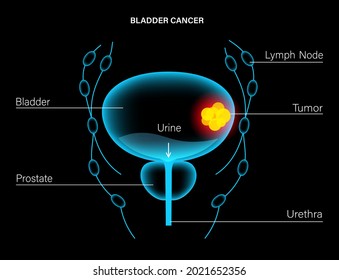 Bladder Cancer Stages 3d Realistic Anatomical Stock Vector (Royalty ...