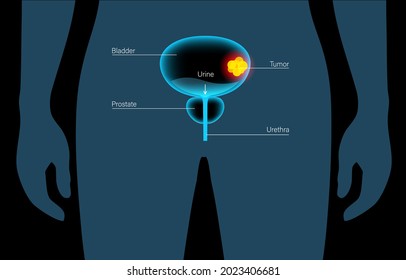 Bladder Cancer Stages 3d Realistic Anatomical Stock Vector (Royalty ...