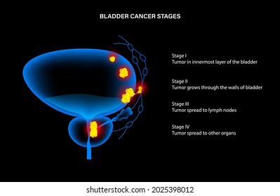 Bladder Cancer Stages 3d Realistic Anatomical Stock Vector (Royalty ...