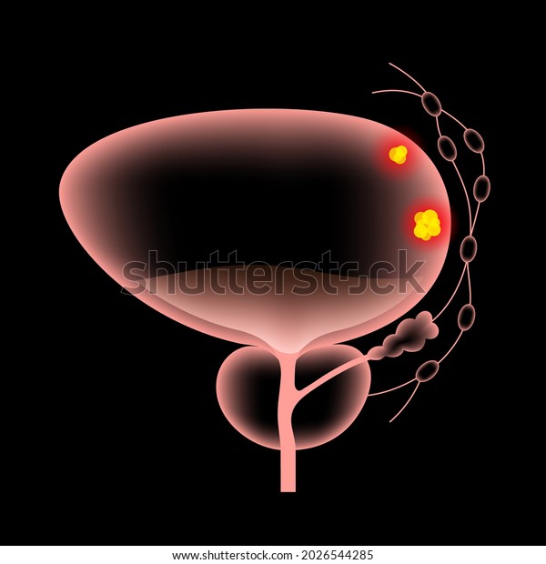 Bladder Cancer Stages 3d Realistic Anatomical Stock Vector (Royalty ...